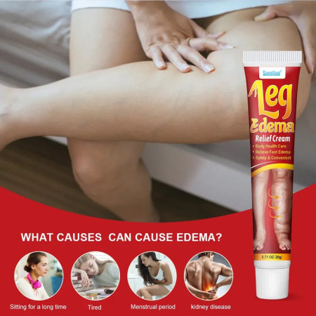 New Natural Anti Edema Cream Remove Arm Leg Swelling Pain Relief Ointment